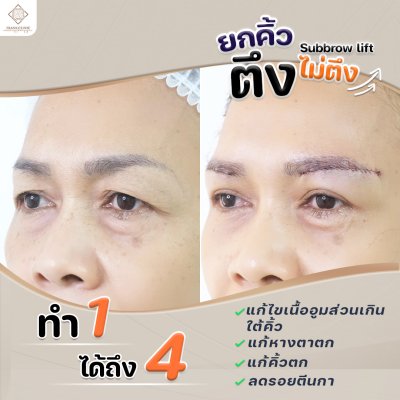 รีวิว ยกคิ้ว เทคนิค SUBBROWLOCK