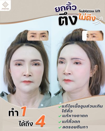 รีวิว ยกคิ้ว เทคนิค SUBBROWLOCK