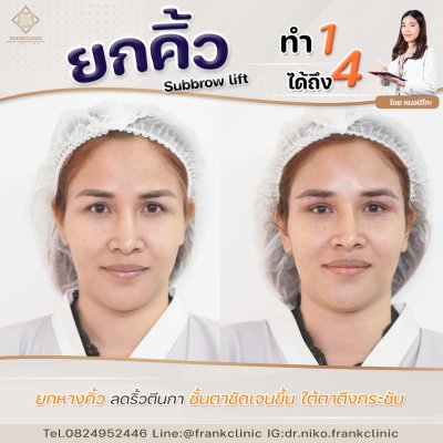 รีวิว ยกคิ้ว เทคนิค SUBBROWLOCK