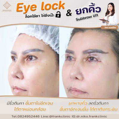 รีวิว ยกคิ้ว เทคนิค SUBBROWLOCK