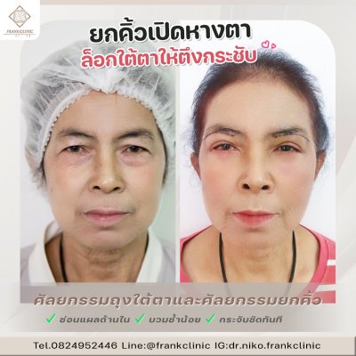 รีวิว ยกคิ้ว เทคนิค SUBBROWLOCK