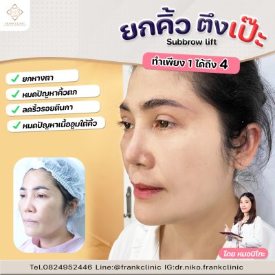 รีวิว ยกคิ้ว เทคนิค SUBBROWLOCK