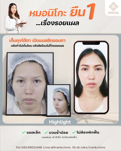 รีวิว ตัดถุงใต้ตา