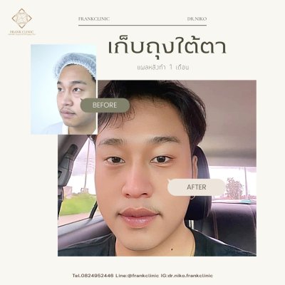 รีวิว ตัดถุงใต้ตา