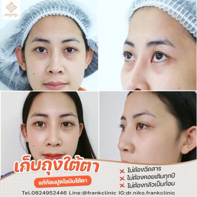 รีวิว ตัดถุงใต้ตา