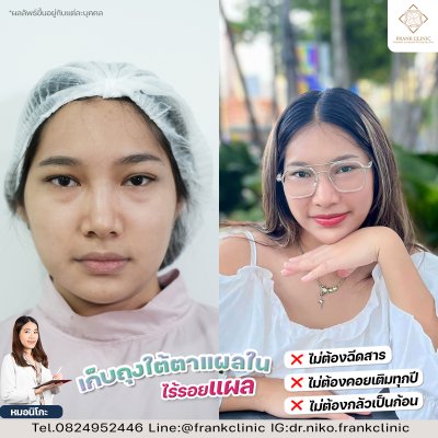 รีวิว ตัดถุงใต้ตา ไร้รอยแผล