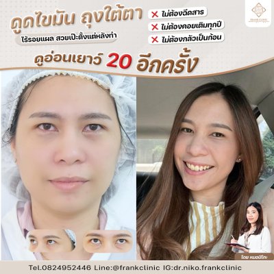 รีวิว ตัดถุงใต้ตา ไร้รอยแผล