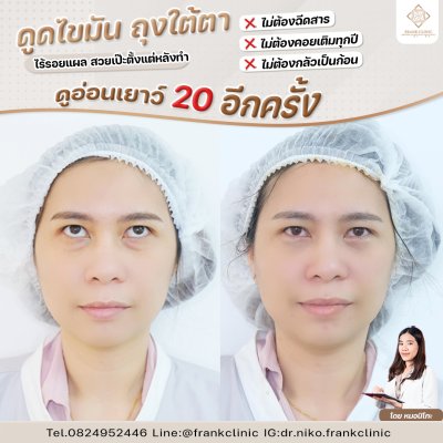 รีวิว ตัดถุงใต้ตา ไร้รอยแผล