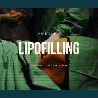 ดูดไขมันทิ้ง (LIPOSUCTION)