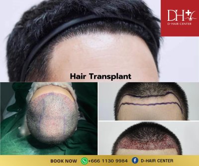 Achieve Natural Hair with Hair Transplant at D-Hair Center Bangkok Hello everyone! I hope you are staying dry and healthy during this rainy season in Thailand. We are excited to share a remarkable transformation from our clinic, D-Hair Center Bangkok, sho