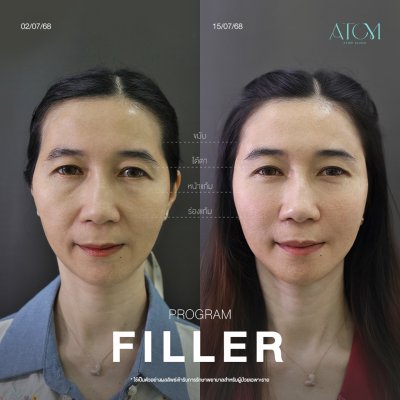 filler ฟิลเลอร์ เทคนิค AT Tri 