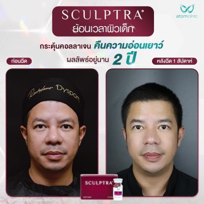 Sculptra Collagen Biostimulator