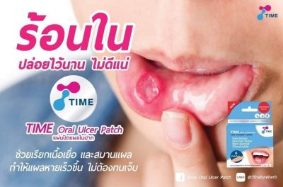 TIME ORAL ULCER PATCH (แผ่นปิดแผลร้อนในช่องปาก)