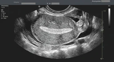 Homogenous Endometrium