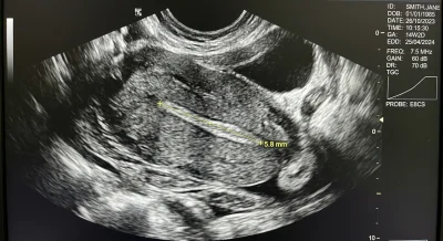 Thin Pattern Endometrium