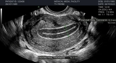 Triple Line Endometrium