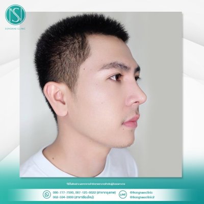 รีวิวเสริมจมูก ผู้ชาย