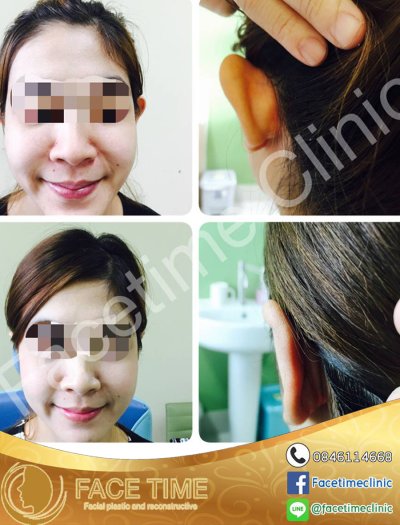 การผ่าตัดบริเวณหู (Cosmetic Surgery For Ears)