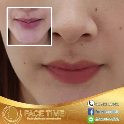 การผ่าตัดริมฝีปาก (Cosmetic Surgery of the Lips)