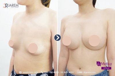 Review breast augmentation