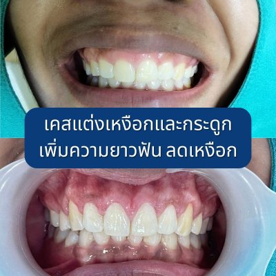ทันตกรรมเพื่อความสวยงาม