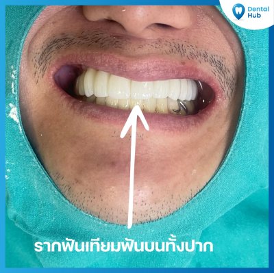 รากฟันเทียม