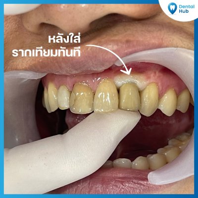 รากฟันเทียม