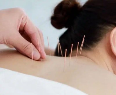 การฝังเข็ม Acupuncture