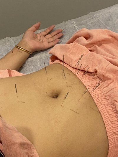 ฝังเข็มกระชับสัดส่วน (Slimimimg Acupuncture)