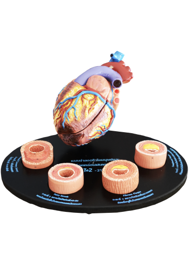 แบบจำลองหัวใจมนุษย์และหลอดเลือดคลอเลสเตอรอล 4 ระยะ (ช่างไทยประดิษฐ์)