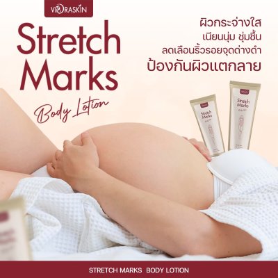 Stretch Marks Body Lotion Stretch Marks Body Lotion