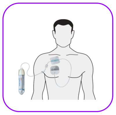 เครื่องควบคุมการให้สาร Nipro Surefuser 100 mL (SFS-1003DP) (1 อัน)