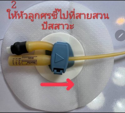Ugo Fix Gentle แผ่นยึดติดสายสวนปัสสาวะ (1 ซอง)