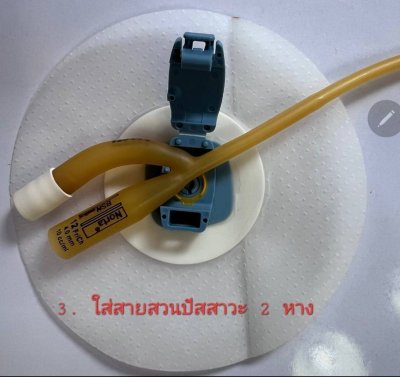 Ugo Fix Gentle แผ่นยึดติดสายสวนปัสสาวะ (1 ซอง)