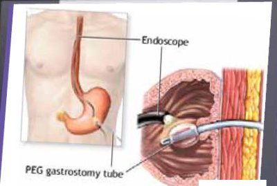 สายให้อาหารทางหน้าท้อง Gastrostomy Silicone Tube (Right Angle) - EndoVive