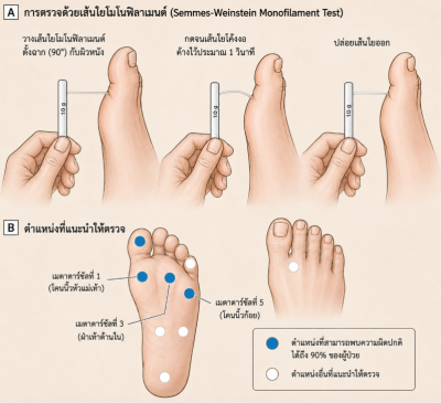 Monofilament ที่ตรวจความรู้สึกเท้า ผู้ป่วยเบาหวาน