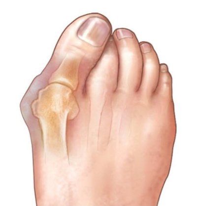 Hallux Valgus Splint - BORT Valco อุปกรณ์แยกนิ้วเท้า (เท้าขวา) เยอรมัน