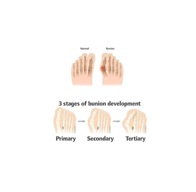 Hallux Valgus Splint - BORT Valco อุปกรณ์แยกนิ้วเท้า (เท้าขวา) เยอรมัน