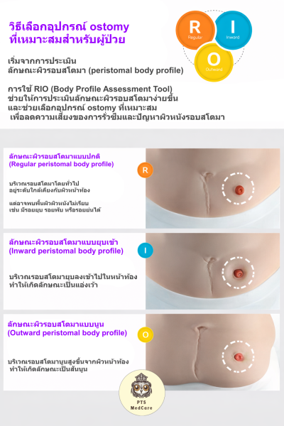 แป้นเรียบ พร้อมถุงอุจจาระ Coloplast Sensura Ostomy Bag Opaque (15580) (1 ชิ้น)