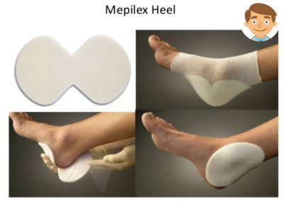 Mepilex Heel 13x20 cm สำหรับแผลที่ส้นเท้า