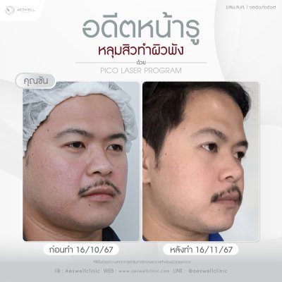 โปรแกรม Pico Laser