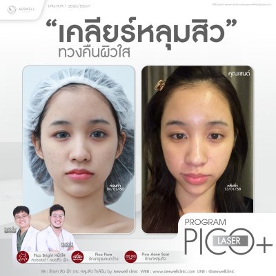 โปรแกรม Pico Laser