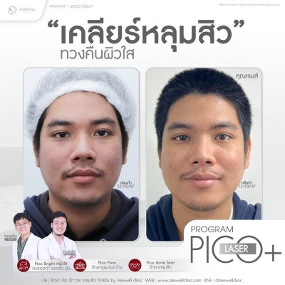 โปรแกรม Pico Laser