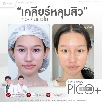 โปรแกรม Pico Laser