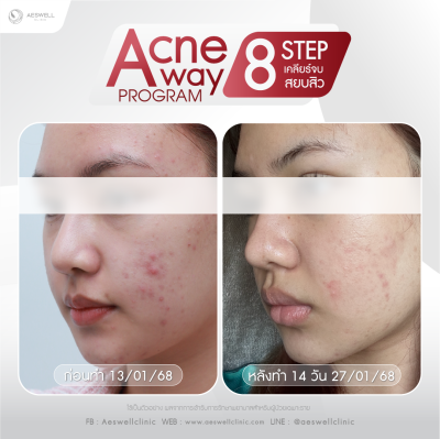 รีวิวจากผู้ใช้บริการจริง โปรแกรม Acne Away