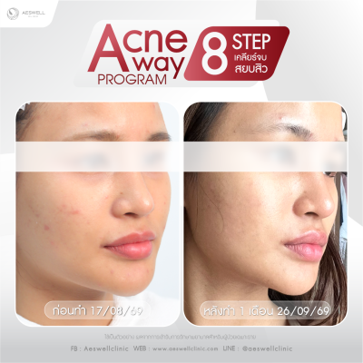 รีวิวจากผู้ใช้บริการจริง โปรแกรม Acne Away