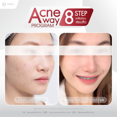 รีวิวจากผู้ใช้บริการจริง โปรแกรม Acne Away