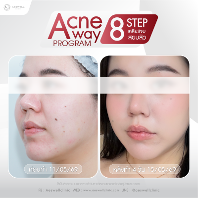รีวิวจากผู้ใช้บริการจริง โปรแกรม Acne Away