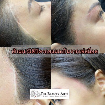 Scalp Micro Picmentation
