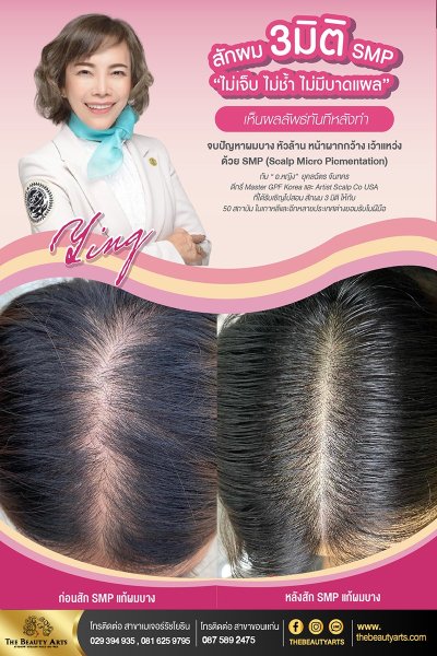 Scalp Micro Picmentation
